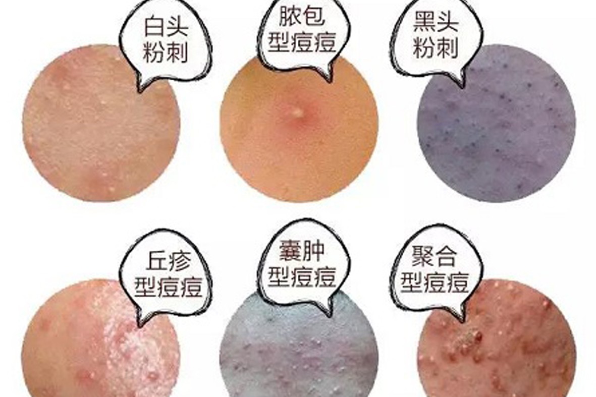 1664159333766064508.jpg 平痘复合剂0.jpg